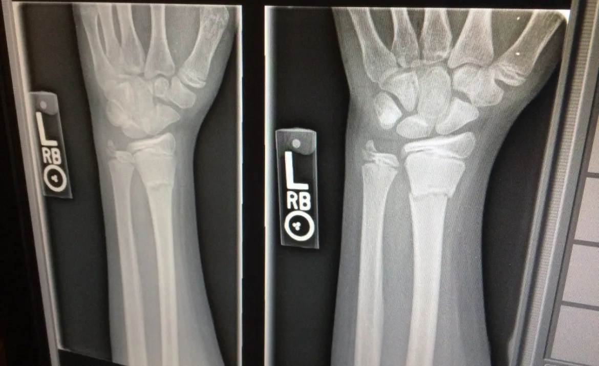 broken bone